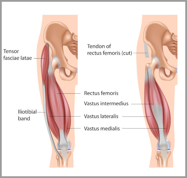 Thigh Pain